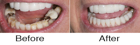 Veneers 1