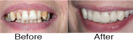 Veneers 2