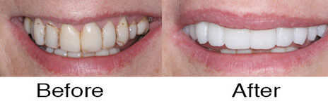 Veneers 9