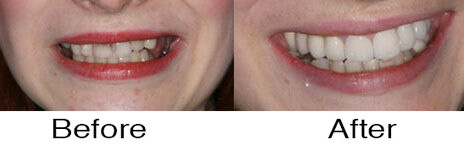 Veneers 8