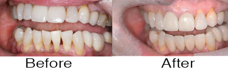 Veneers 7