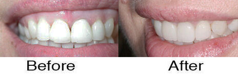 Veneers 5