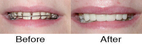 Veneers 4