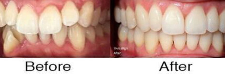 Invisalign® 8
