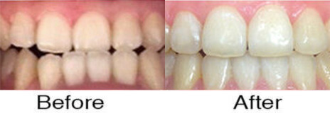 Invisalign® 1