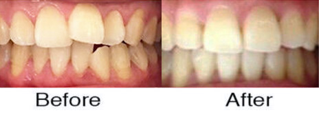 Invisalign® 2