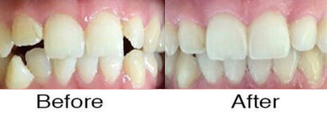 Invisalign® 3