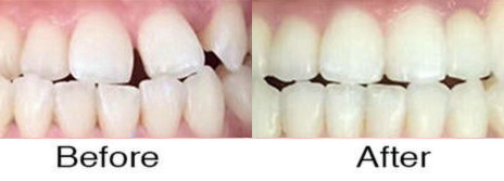 Invisalign® 4