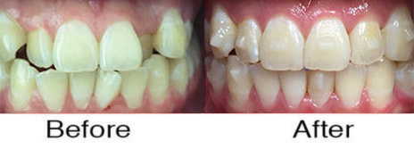 Invisalign® 5