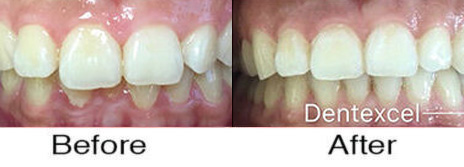 Invisalign® 7
