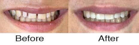 Veneers 3